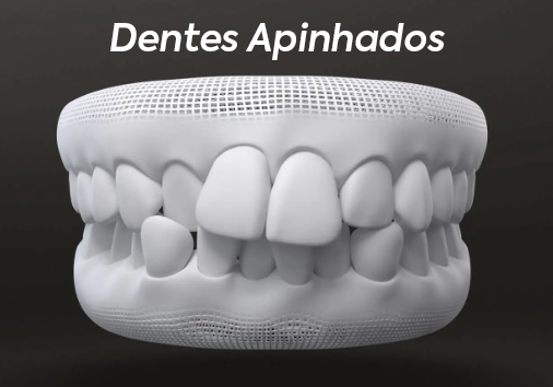 Dentes-Apinhados.png