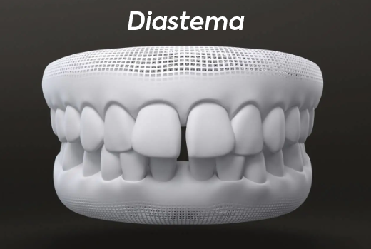 Diastema.png