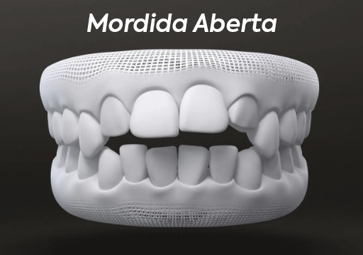 Mordida-Aberta.png