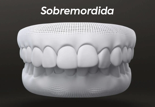 Sobremordida.png